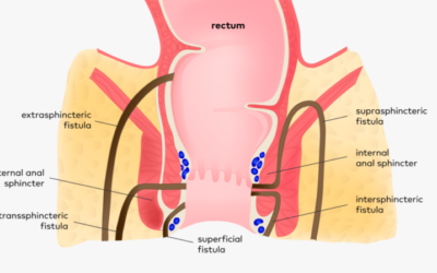 Anal Fistula