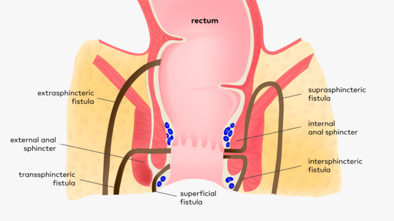 Anal Fistula