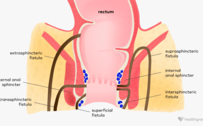 Anal Fistula
