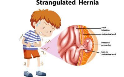 Hernia: Causes, Symptoms, Diagnosis, and Treatment